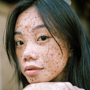 Hyperpigmentation